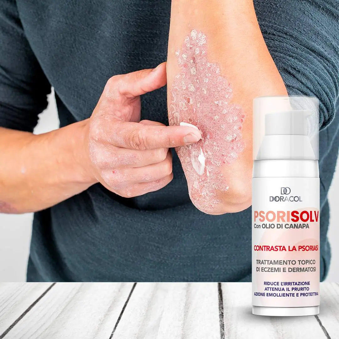 Sorisolv - Psoriasis Cream